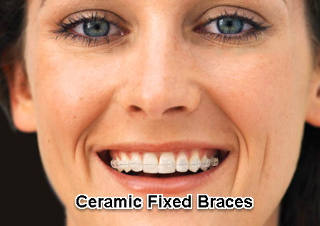 Ceramic Braces